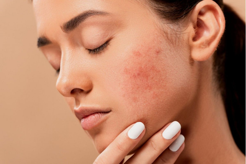 skincare untuk kulit berjerawat

