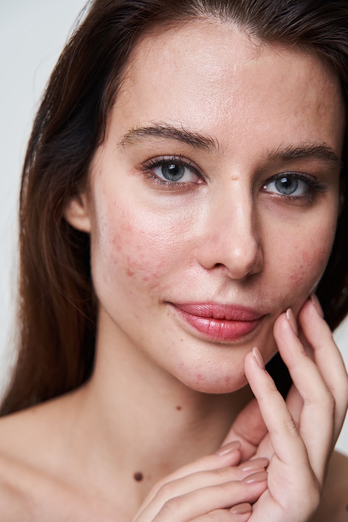 Kulit yang kekurangan kelembapan akan menimbulkan gejala kemerahan dan dapat memperparah kondisi acne